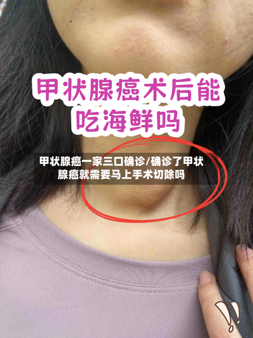 甲状腺癌一家三口确诊/确诊了甲状腺癌就需要马上手术切除吗-第3张图片