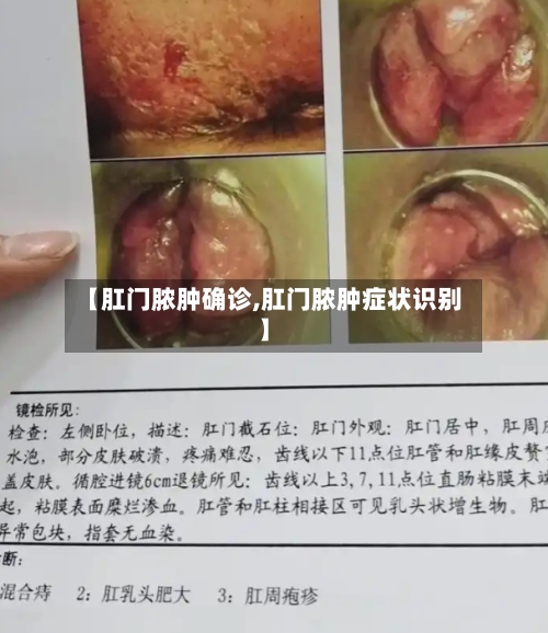 【肛门脓肿确诊,肛门脓肿症状识别】