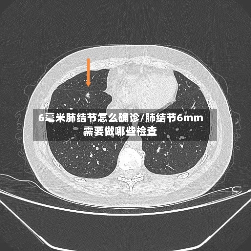 6毫米肺结节怎么确诊/肺结节6mm需要做哪些检查-第3张图片