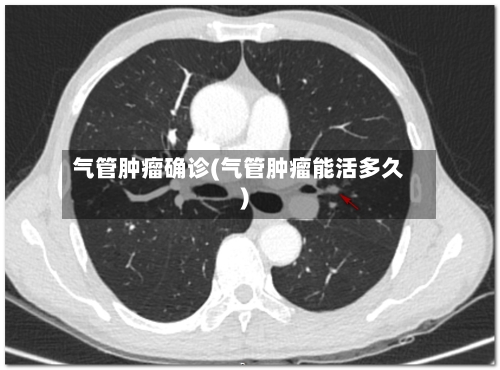 气管肿瘤确诊(气管肿瘤能活多久)-第2张图片
