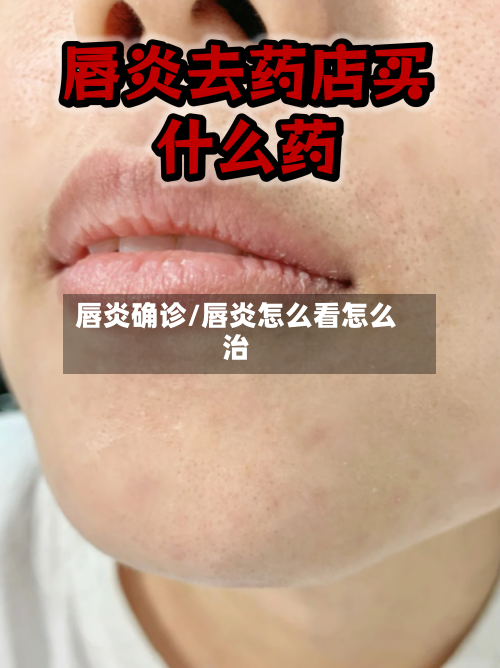 唇炎确诊/唇炎怎么看怎么治