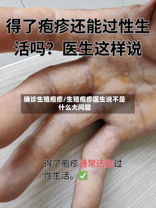 确诊生殖疱疹/生殖疱疹医生说不是什么大问题-第3张图片