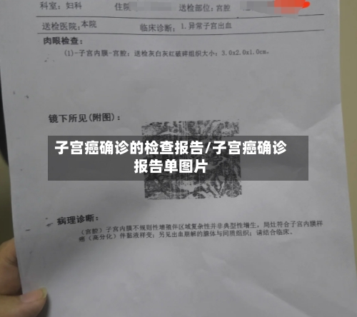 子宫癌确诊的检查报告/子宫癌确诊报告单图片-第2张图片